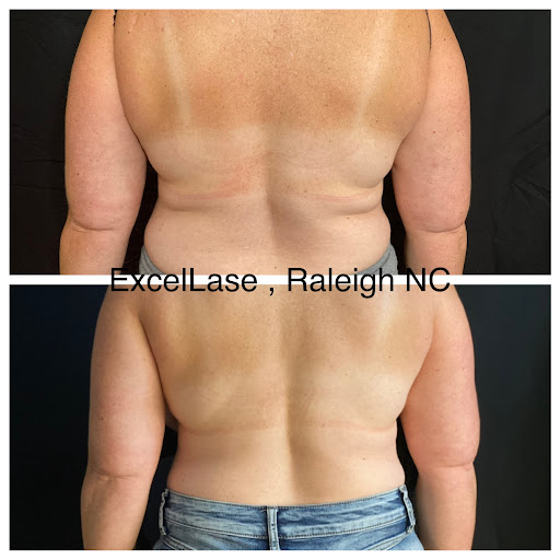 Explore finger print tattoo ideas, creative tattoo ideas in Raleigh, available at ExcelLase