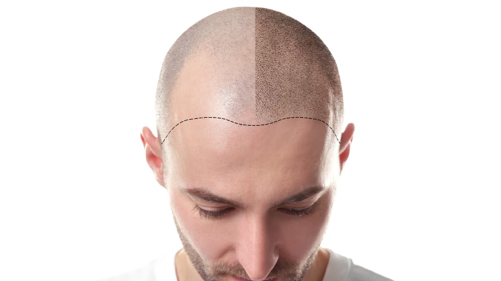 Downey Hair Loss Solutions SMP 90241