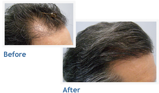 NuHair Medical Hair Transplant Centre