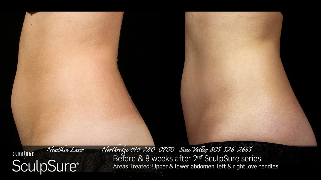 NewSkin Laser Center 93065
