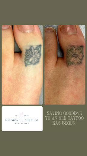 Explore globe tattoo ideas, creative tattoo ideas in Brunswick, available at Brunswick Medical Aesthetics