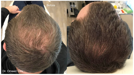 Sani Institute For Hair Restoration - PRP Therapy - Los Gatos, Sunnyvale, Cupertino, & San Jose