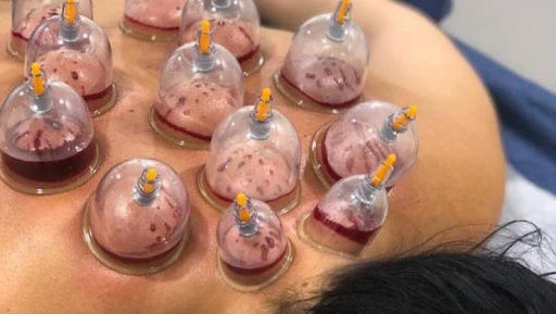 Hijama detox therapy