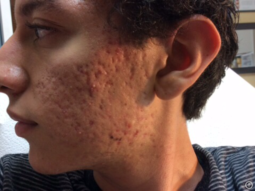 Explore lily flower tattoo ideas, creative tattoo ideas in Victorville, available at Goawaytats tattoo removal