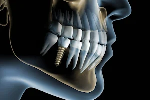 Gaziemir diş kliniği Dt.Özgen Çakır implant uygulamaları image
