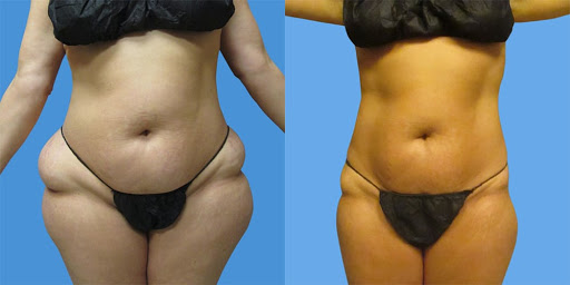 Tummy tuck clinics in Cincinnati