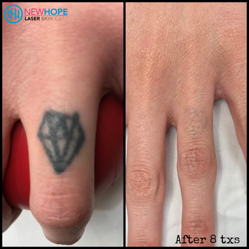 Explore matching tattoo ideas for brothers, creative tattoo ideas in Westminster, available at Newhope Laser Skin Care