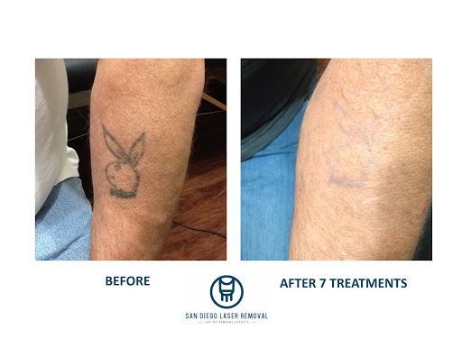 Explore zodiac sign tattoo ideas, creative tattoo ideas in San Diego, available at Removery Tattoo Removal & Fading