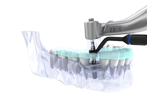 Zahnimplantat Frankfurt, 3D-Implantologie, Navigierte Implantate, Knochenaufbau