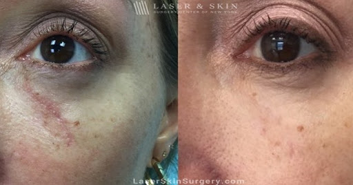 Explore psych tattoo ideas, creative tattoo ideas in Southampton, available at Laser & Skin Surgery Center of New York - Southampton