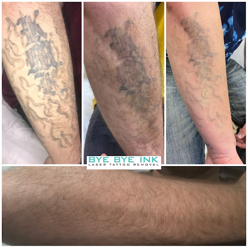 Explore 1988 tattoo ideas, creative tattoo ideas in Middle Village, available at Bye Bye Ink Laser Tattoo Removal