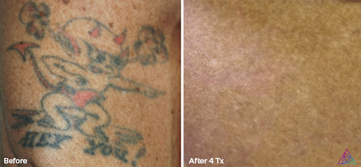 Explore apple tattoo ideas, creative tattoo ideas in Fort Myers, available at Laser Tattoo Removal by Tatt Cemetery