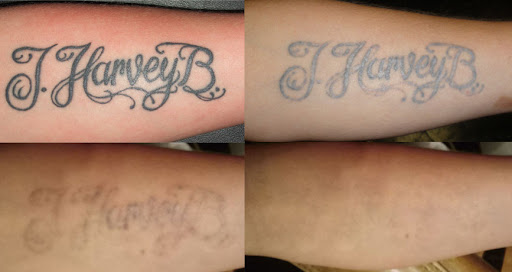 Explore cover up ideas for big tattoos, creative tattoo ideas in Lincoln, available at Fade Away Laser