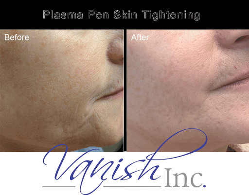 Explore $uicideboy$ tattoo ideas, creative tattoo ideas in Williamsport, available at Vanish Laser & Skin, Inc.
