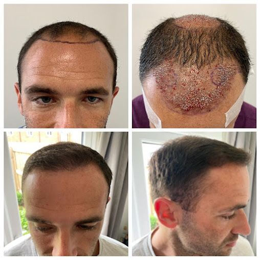 عيادات أفضل لزراعة الشعر - كارديف - Better Hair Transplant Clinics - Cardiff