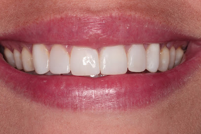 Porselen Diş İmplant Zirkonyum Kaplama Diş Protezi Lamine