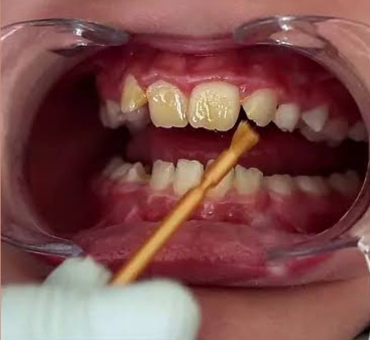 ODONTOPEDIATRÍA Y ORTODONCIA.ATENCION DENTAL PARA NIÑOS.ESPECIALISTA ODONTOPEDIATRA DRA. MILAGROS TELLO