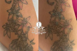 Boca Raton Laser Hair Removal and Laser Tattoo Removal iBeauty Makeover image