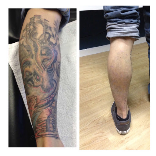 Explore 2x2 tattoo size ideas, creative tattoo ideas in Lawrence, available at Removery Tattoo Removal & Fading