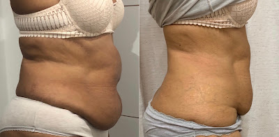 Expert-byJ : Amincissement et Beauté : Cryolipolyse Marseille 8ème à Marseille