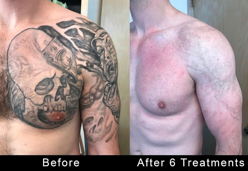 Explore women's arm tattoo ideas, creative tattoo ideas in Covington, available at Northshore Tattoo Removal