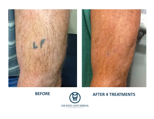 Explore army tattoo ideas, creative tattoo ideas in San Diego, available at Removery Tattoo Removal & Fading