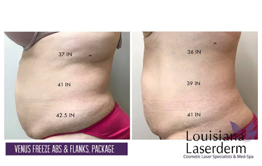 Explore cover up ideas for wrist tattoo, creative tattoo ideas in Baton Rouge, available at Louisiana Laserderm