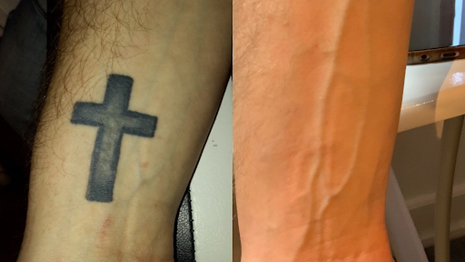Derby Tattoo Removal