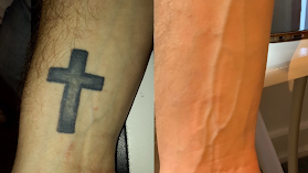 Derby Tattoo Removal