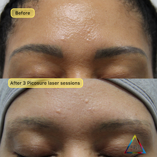 Explore mikasa tattoo ideas, creative tattoo ideas in New York, available at Ag2g Laser Tattoo Removal & MedSpa