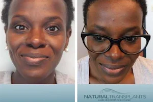 Natural Transplants, Hair Restoration Clinic image