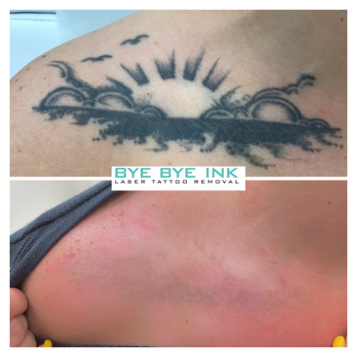Explore alzheimer tattoo ideas, creative tattoo ideas in Middle Village, available at Bye Bye Ink Laser Tattoo Removal