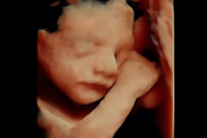 ANH 3D /4D Ultrasound - India's most Advanced 3D Ultrasound image