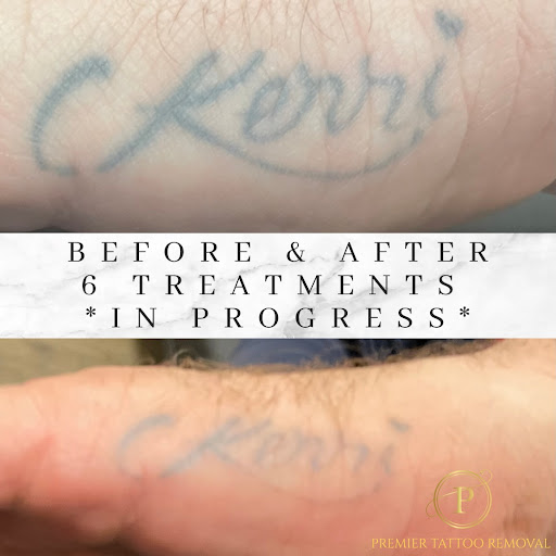 Explore lip tattoo ideas, creative tattoo ideas in Mckinney, available at Premier Tattoo Removal