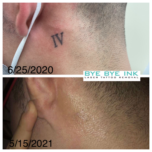 Explore the fiend tattoo ideas, creative tattoo ideas in Middle Village, available at Bye Bye Ink Laser Tattoo Removal