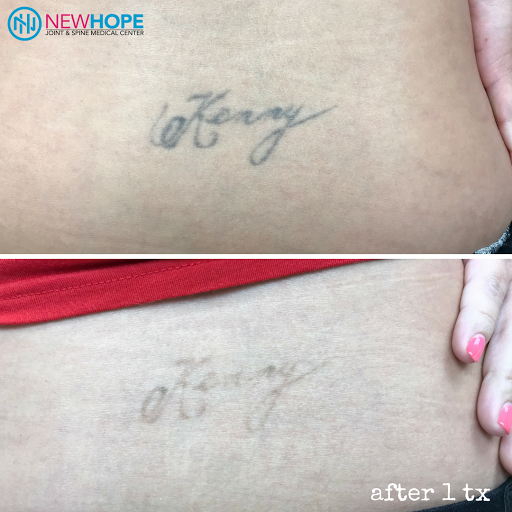 Explore marker tattoo ideas, creative tattoo ideas in Westminster, available at Newhope Laser Skin Care