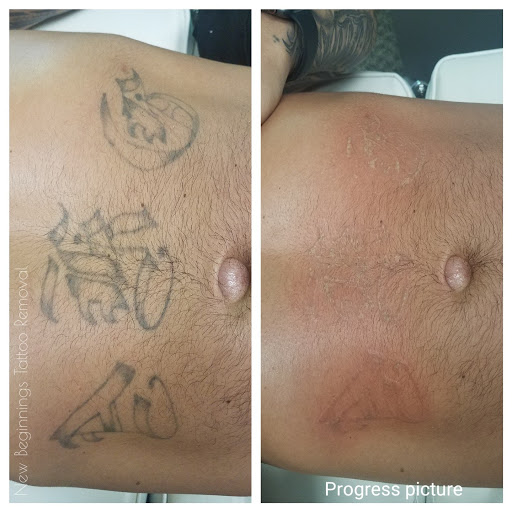 Explore jolly roger tattoo ideas, creative tattoo ideas in Arvada, available at New Beginnings Tattoo Removal