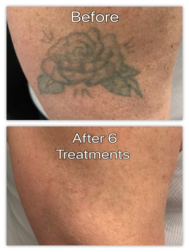 Explore 2 dog tattoo ideas, creative tattoo ideas in Honolulu, available at Removery Tattoo Removal & Fading
