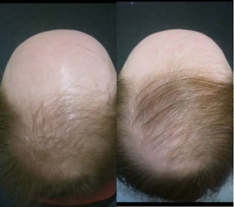 Hove Hair Clinic - Hove Hair Clinic