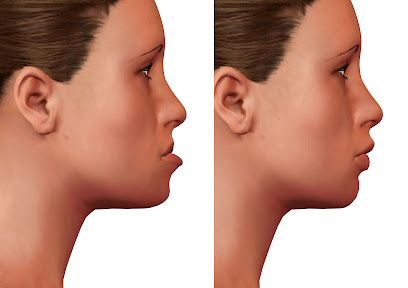 Ventura Jaw Surgery and TMJ