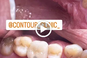 Dr. Romas Contour Clinic : Dental Clinic in Pimpri : Root Canal : Invisalign : Implant : Dentist In Pimpri : Re RCT image