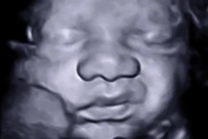 Amazing Grace Ultrasound image