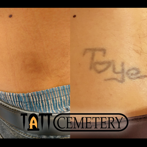 Explore lupus tattoo ideas, creative tattoo ideas in Fort Myers, available at Laser Tattoo Removal by Tatt Cemetery