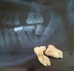 Denti vitale