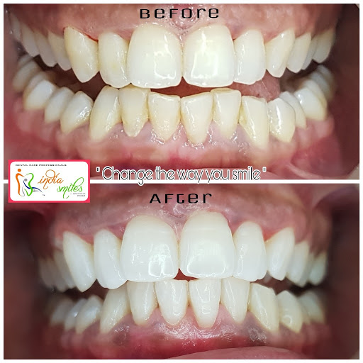 India Smiles Dental Clinic - Tooth Implants,Root Canal Specialist, Cosmetic Dentistry, Braces, Kids Dentistry, Special Care For Elderly, Full Mouth Rehabilitation, Family Dentistry.
