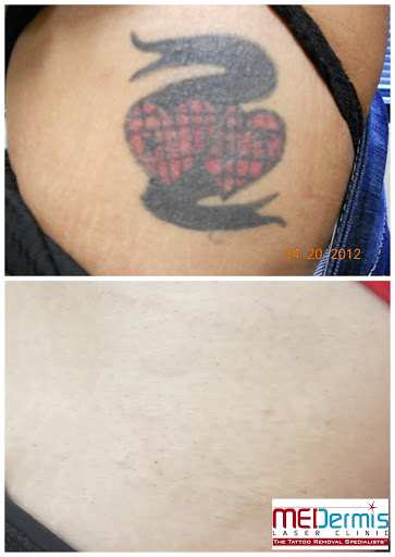 Explore enough tattoo ideas, creative tattoo ideas in San Antonio, available at MEDermis Tattoo Removal