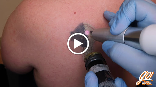 Explore chrome tattoo ideas, creative tattoo ideas in Allentown, available at Removery Tattoo Removal & Fading