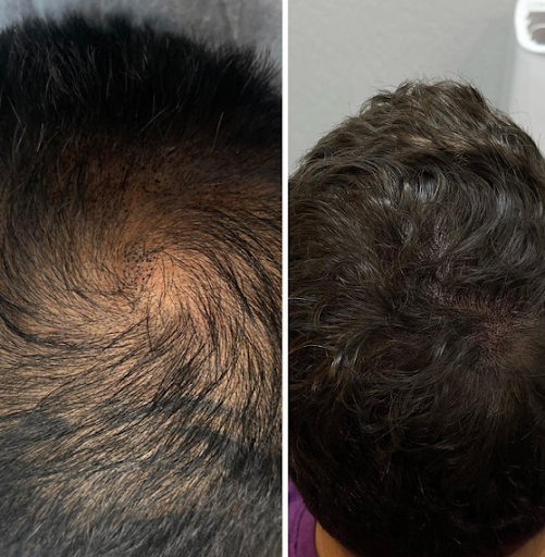 Explore jessica tattoo ideas, creative tattoo ideas in Roseville, available at NuHair Ink. Scalp MicroPigmentation & Aesthetic Clinic of Sacramento