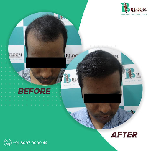 Bloom Hair Transplant