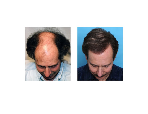 Hair Transplantation Clinic «Bosley Medical - Atlanta», reviews and photos, 3379 Peachtree Rd NE #800, Atlanta, GA 30326, USA